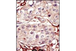 Formalin-fixed and paraffin-embedded human cancer tissue reacted with the primary antibody, which was peroxidase-conjugated to the secondary antibody, followed by DAB staining. (Aurora Kinase B 抗体  (AA 283-313))
