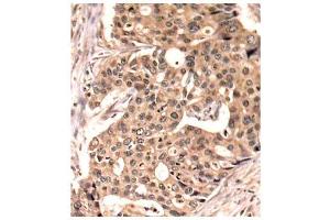 Immunohistochemistry of paraffin-embedded human breast carcinoma tissue, using Phospho-PXN-Y118 antibody (ABIN2987461). (Paxillin 抗体  (pTyr118))