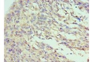 Immunohistochemistry of paraffin-embedded human cervical cancer using ABIN7156720 at dilution of 1:100 (Interleukin enhancer-binding factor 3 (ILF3) (AA 785-894) 抗体)