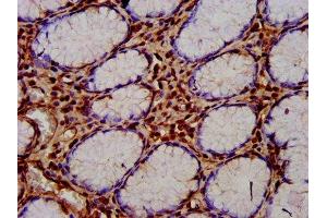 IHC image of ABIN7148543 diluted at 1:400 and staining in paraffin-embedded human gastric cancer performed on a Leica BondTM system. (CUTC 抗体  (AA 1-64))
