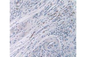 IHC-P analysis of Human Rectum Cancer Tissue, with DAB staining. (CDK2 抗体  (AA 94-198))