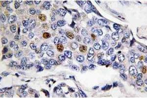 Immunohistochemistry (IHC) analyzes of POLR3A antibody in paraffin-embedded human breast carcinoma tissue. (POLR3A 抗体)