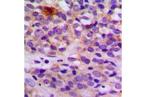 Immunohistochemical analysis of ARRDC4 staining in human breast cancer formalin fixed paraffin embedded tissue section. (ARRDC4 抗体  (Center))