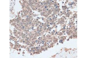 Immunohistochemistry of paraffin-embedded Human lung cancer using ZNF562 Polyclonal Antibody at dilution of 1:100 (40x lens). (ZNF562 抗体)