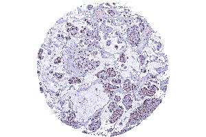 Muscle invasive urothelial carcinoma with strong SMARCA2 positivity of tumor cells