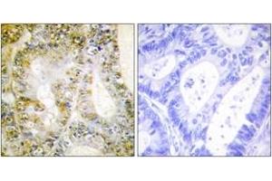 Immunohistochemistry analysis of paraffin-embedded human breast carcinoma tissue, using Catenin-beta1 Antibody. (CTNNB1 抗体  (AA 626-675))