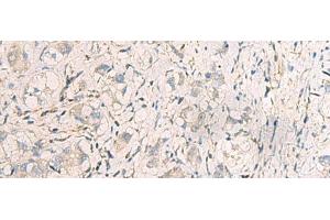 Immunohistochemistry of paraffin-embedded Human liver cancer tissue using SUSD3 Polyclonal Antibody at dilution of 1:95(x200) (SUSD3 抗体)