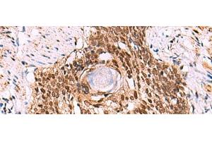 Immunohistochemistry of paraffin-embedded Human esophagus cancer tissue using LDB1 Polyclonal Antibody at dilution of 1:70(x200) (LIM Domain Binding 1 Protein 抗体)