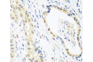 Immunohistochemistry of paraffin-embedded Human stomach cancer using POLR2E Polyclonal Antibody at dilution of 1:100 (40x lens). (POLR2E 抗体)