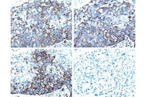 Ezrin (pT567) staining on human breast cancer. (Ezrin 抗体  (pThr567))