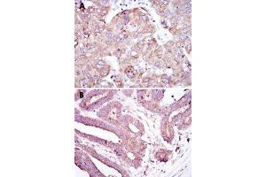 Immunohistochemical analysis of paraffin-embedded human liver cancer tissue (A) and stomach cancer tissue (B) using RBP4 monoclonal antobody, clone 4C2  with DAB staining. (RBP4 抗体)