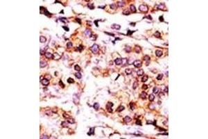 Formalin-fixed and paraffin-embedded human cancer tissue reacted with the primary antibody, which was peroxidase-conjugated to the secondary antibody, followed by AEC staining. (PANK1 抗体  (AA 332-360))