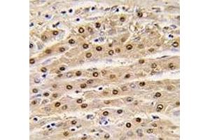 IHC analysis of FFPE human hepatocarcinoma tissue stained with anti-GAPDH antibody (GAPDH 抗体  (AA 62-91))