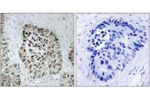 Immunohistochemistry analysis of paraffin-embedded human lung carcinoma tissue, using Artemis (Ab-516) Antibody. (DCLRE1C 抗体  (AA 482-531))