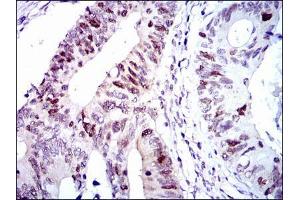 Immunohistochemical analysis of paraffin-embedded colon cancer tissues using CDK2 mouse mAb with DAB staining. (CDK2 抗体)