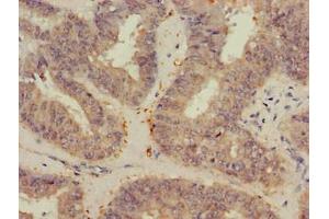 Immunohistochemistry of paraffin-embedded human endometrial cancer using ABIN7175368 at dilution of 1:100
