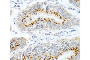 Immunohistochemistry of paraffin-embedded Human colon carcinoma using FAM3B Polyclonal Antibody at dilution of 1:100 (40x lens). (FAM3B 抗体)
