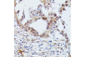 Immunohistochemistry of paraffin-embedded human lung cancer using IGHMBP2 antibody (ABIN7267848) at dilution of 1:100 (40x lens). (IGHMBP2 抗体  (AA 540-720))