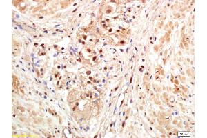 Formalin-fixed and paraffin embedded human gastric carcinoma labeled with Anti-PAPOG Polyclonal Antibody, Unconjugated (ABIN1714858) at 1:200 followed by conjugation to the secondary antibody and DAB staining. (PAPOLG 抗体  (AA 101-200))