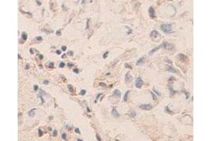 Immunohistochemical staining of formalin-fixed paraffin-embedded human lung carcinoma tissue showing membrane and nuclear staining with PDCD6 polyclonal antibody  at 1 : 100 dilution.