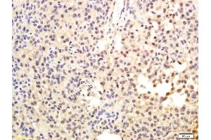 Formalin-fixed and paraffin embedded human hepatoma labeled with Anti-TRT/TERT Polyclonal Antibody, Unconjugated (ABIN726650) followed by conjugation to the secondary antibody and DAB staining