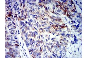 Immunohistochemical analysis of paraffin-embedded bladder cancer tissues using CD64 mouse mAb with DAB staining. (FCGR1A 抗体  (AA 16-145))