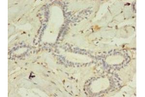 Immunohistochemistry of paraffin-embedded human breast cancer using ABIN7158507 at dilution of 1:100 (ACSL4 抗体  (AA 457-670))