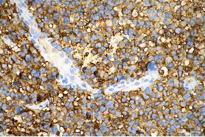 Immunohistochemistry was performed on paraffin-embedded human glioblastoma using tubulin III antibody (ABIN7800669), 1:500).