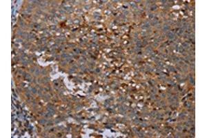 The image on the left is immunohistochemistry of paraffin-embedded Human cervical cancer tissue using ABIN7191748(OTOR Antibody) at dilution 1/30, on the right is treated with synthetic peptide. (Otoraplin 抗体)