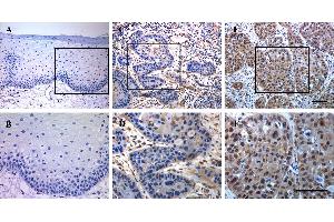 Immunohistochemical staining of TEAD4 in human HNSCC samples. (TEAD4 抗体  (Center))