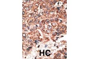 Formalin-fixed and paraffin-embedded human cancer tissue reacted with the primary antibody, which was peroxidase-conjugated to the secondary antibody, followed by DAB staining. (MMP20 抗体  (AA 233-262))