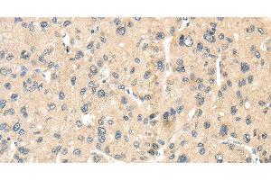 Immunohistochemistry of paraffin-embedded Human liver cancer tissue using LOXL3 Polyclonal Antibody at dilution 1:35