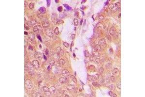 Immunohistochemical analysis of TPH1 staining in human breast cancer formalin fixed paraffin embedded tissue section. (Tryptophan Hydroxylase 1 抗体  (N-Term))