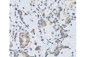 Immunohistochemistry of paraffin-embedded Human gastric cancer using SLC2A13 Polyclonal Antibody at dilution of 1:100 (40x lens). (SLC2A13 抗体)