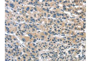 The image on the left is immunohistochemistry of paraffin-embedded Human liver cancer tissue using ABIN7192957(TUSC1 Antibody) at dilution 1/30, on the right is treated with synthetic peptide. (TUSC1 抗体)