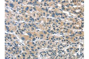 The image on the left is immunohistochemistry of paraffin-embedded Human liver cancer tissue using ABIN7192957(TUSC1 Antibody) at dilution 1/30, on the right is treated with synthetic peptide. (TUSC1 抗体)