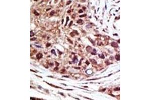 Formalin-fixed and paraffin-embedded human cancer tissue reacted with the primary antibody, which was peroxidase-conjugated to the secondary antibody, followed by AEC staining. (USP14 抗体  (N-Term))