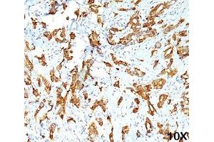 IHC testing of human breast carcinoma (10X) stained with HSP27 antibody (G3. (HSP27 抗体)