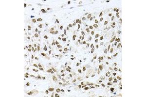 Immunohistochemistry of paraffin-embedded human lung cancer using BCCIP antibody. (BCCIP 抗体  (AA 1-314))