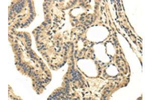 The image on the left is immunohistochemistry of paraffin-embedded Human thyroid cancer tissue using ABIN7130215(MED16 Antibody) at dilution 1/20, on the right is treated with fusion protein. (MED16 抗体)