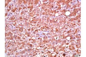 paraformaldehyde-fixed, paraffin embedded human live carcinoma tissue, Antigen retrieval by boiling in sodium citrate buffer(pH6) for 15min, Block endogenous peroxidase by 3% hydrogen peroxide for 30 minutes, Blocking buffer (normal goat serum) at 37°C for 20min, Antibody incubation with Rabbit Anti-PDK1 (Ser241) Polyclonal Antibody, Unconjugated  at 1:500 overnight at 4°C, followed by a conjugated secondary and DAB staining (PDPK1 抗体  (pSer241))