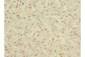 Immunohistochemistry of paraffin-embedded human liver cancer using ABIN7157915 at dilution of 1:100 (LSS 抗体  (AA 1-300))