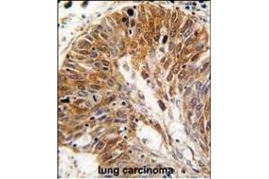 Formalin-fixed and paraffin-embedded human lung carcinoma tissue reacted with PSMD11 antibody (C-term), which was peroxidase-conjugated to the secondary antibody, followed by DAB staining. (PSMD11 抗体  (C-Term))