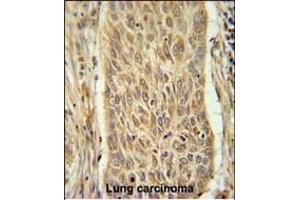 INMT Antibody (Center) (ABIN651667 and ABIN2840351) immunohistochemistry analysis in formalin fixed and paraffin embedded human lung carcinoma followed by peroxidase conjugation of the secondary antibody and DAB staining. (INMT 抗体  (AA 101-128))