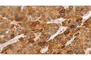 Immunohistochemistry of paraffin-embedded Human liver cancer tissue using LTB Polyclonal Antibody at dilution 1:45 (LTB 抗体)