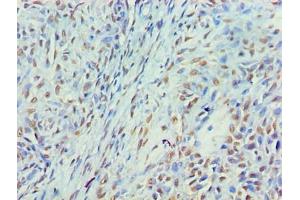 Immunohistochemistry of paraffin-embedded human breast cancer using ABIN7160405 at dilution of 1:100 (MYEF2 抗体  (AA 372-576))
