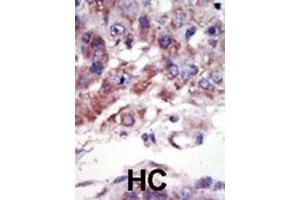 Formalin-fixed and paraffin-embedded human cancer tissue reacted with the primary antibody, which was peroxidase-conjugated to the secondary antibody, followed by AEC staining. (JNK2 抗体  (C-Term))