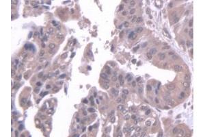 Detection of STK39 in Human Liver cancer Tissue using Polyclonal Antibody to Serine/Threonine Kinase 39 (STK39) (STK39 抗体  (AA 63-545))