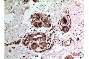 Immunohistochemistry (IHC) analysis of paraffin-embedded Human Breast Cancer, antibody was diluted at 1:100. (IL-10 抗体  (Internal Region))