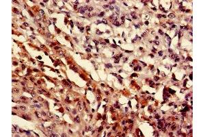 IHC image of ABIN7160506 diluted at 1:400 and staining in paraffin-embedded human melanoma performed on a Leica BondTM system. (MEF2D 抗体  (AA 299-509))